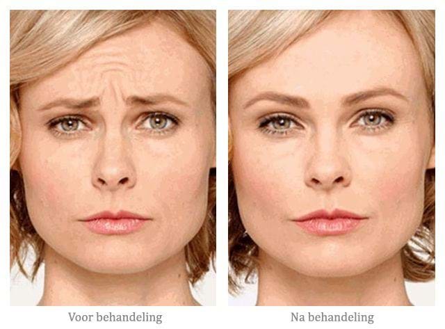 rimpels behandelen rimpels behandelen